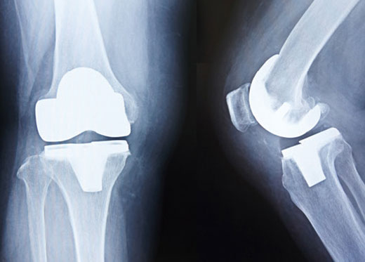 人工膝関節置換後のレントゲン（正面と側面）