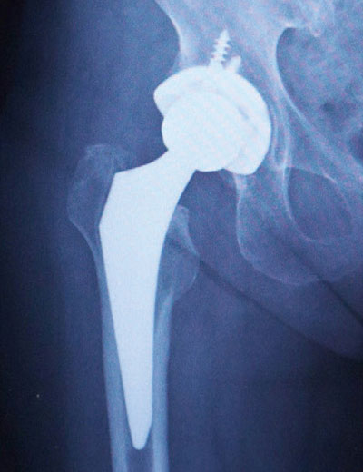 人工股関節置換後のレントゲン
