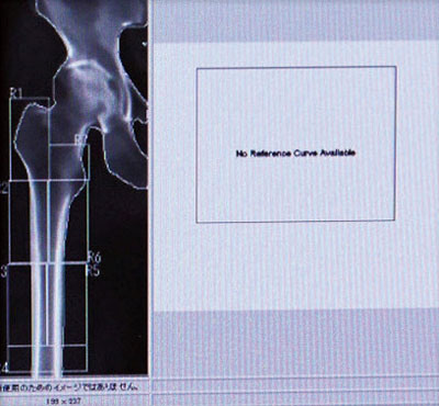 骨密度測定画面