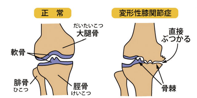 変形性膝関節症