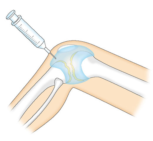 ヒアルロン酸の関節内注射