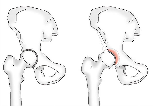 正常（左）寛骨臼形成不全（右）