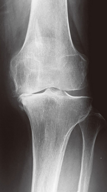 変形性膝関節症のレントゲン（膝の内側が痛んでいます）