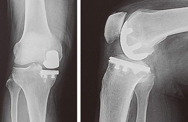 人工膝関節部分置換術後のレントゲン（正面と側面）