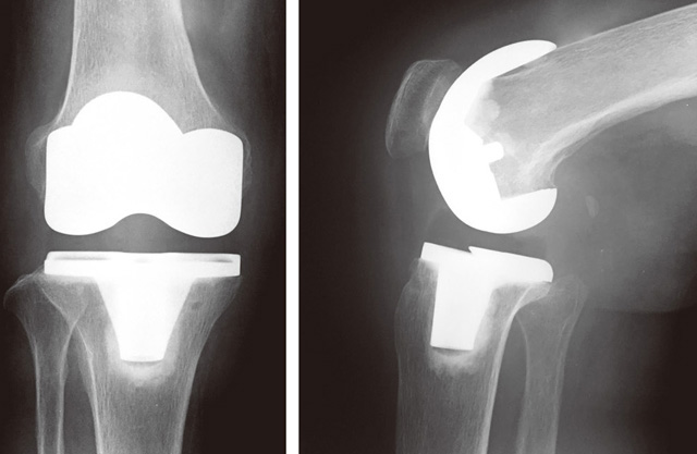 人工膝関節全置換術後のレントゲン（正面と側面）