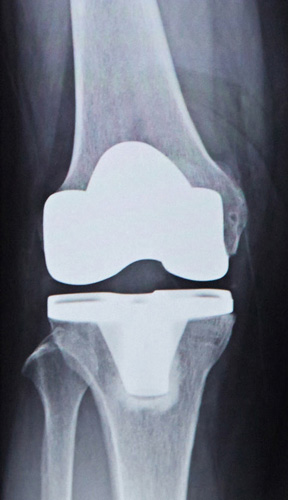 全人工膝関節置換術のレントゲン