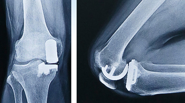 人工膝関節部分置換術後のレントゲン（正面と側面）