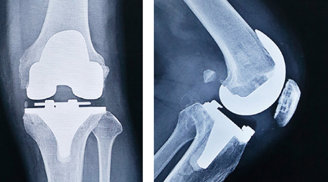 人工膝関節全置換術後のレントゲン（正面と側面）