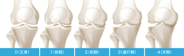変形性膝関節症の5 段階