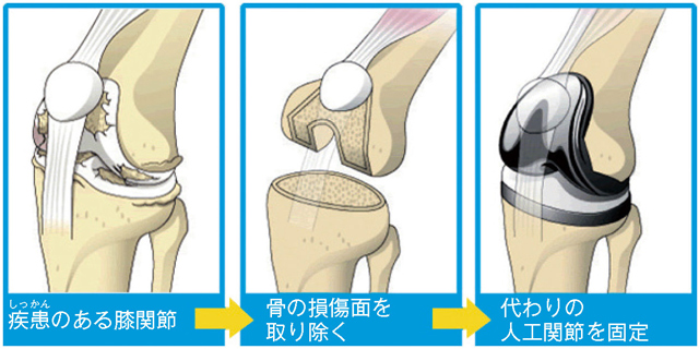 人工膝関節置換術の流れ
