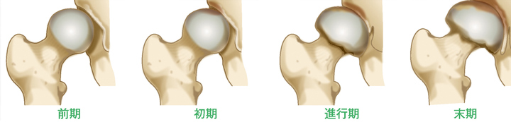 変形性股関節症の進行