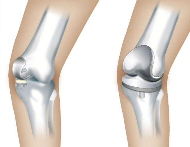 人工膝関節部分置換術（左）と人工膝関節全置換術（右）