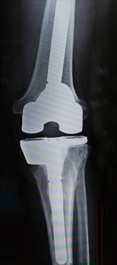 人工膝関節全置換術後のレントゲン