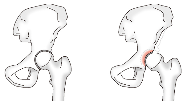 正常な股関節と臼蓋形成不全