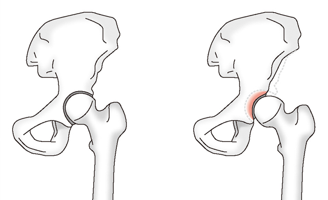 通常の股関節（左）と臼蓋形成不全（右）
