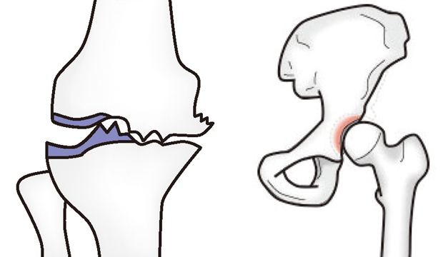 変形性膝関節症（左）と寛骨臼形成不全（右）