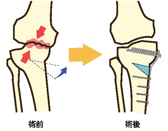 膝関節の骨切り術