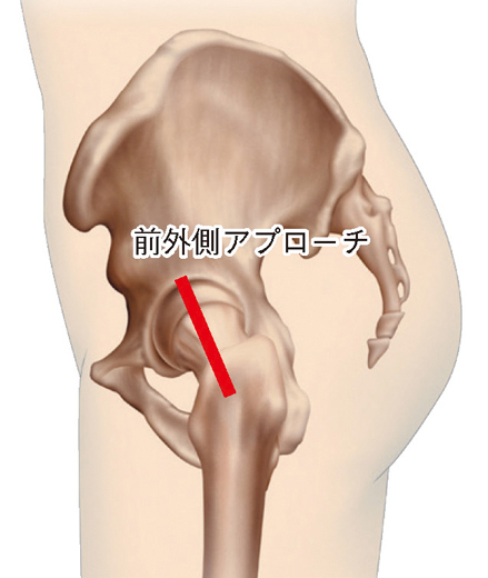 人工股関節置換術