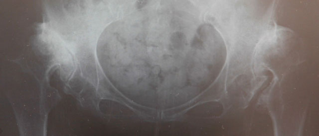 変形性股関節症（両側高位脱臼）のレントゲン
