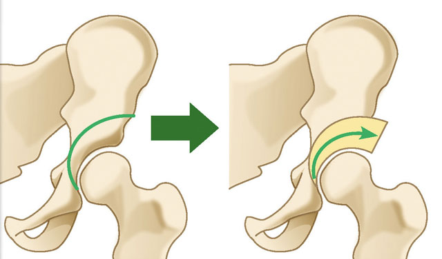 寛骨臼回転骨切り術