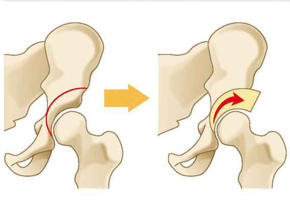骨切り術（股関節）
