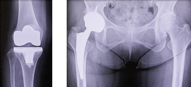 人工膝関節置換術後と人工股関節置換術後のレントゲン