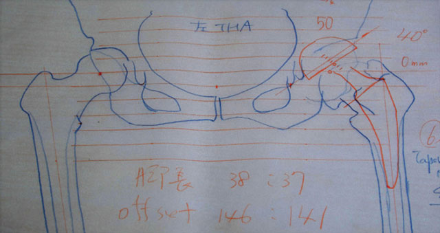 手書きの術前計画