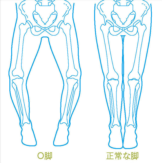 O脚と正常な脚