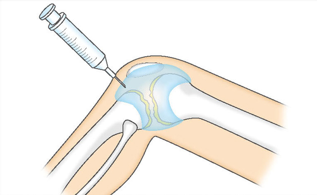 ヒアルロン酸の関節内注射