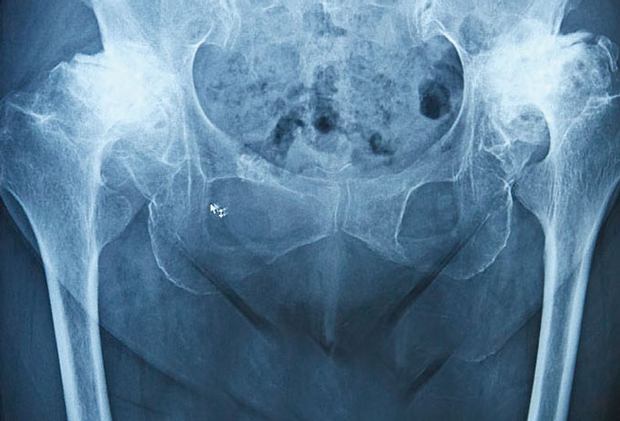変形性股関節症のレントゲン
