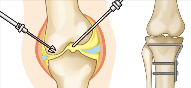 関節鏡手術と骨切り術