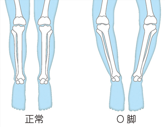 正常な脚とO脚