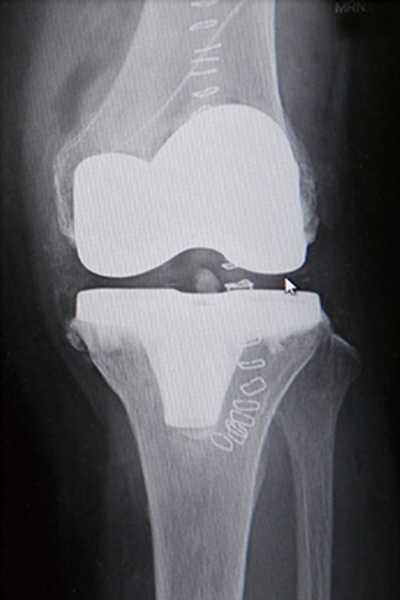人工膝関節置換術後のレントゲン
