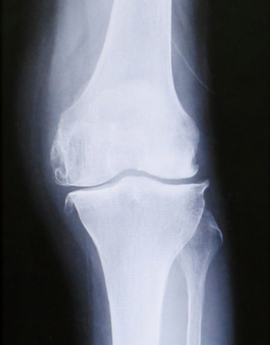 変形性膝関節症のレントゲン