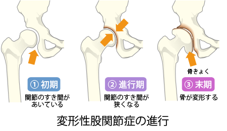船山 敦 先生 日本人に多い 変形性股関節症 原因のほとんどは臼蓋形成不全 股関節の痛み 違和感や不具合は早めに股関節の専門医に相談を 人工関節ドットコム