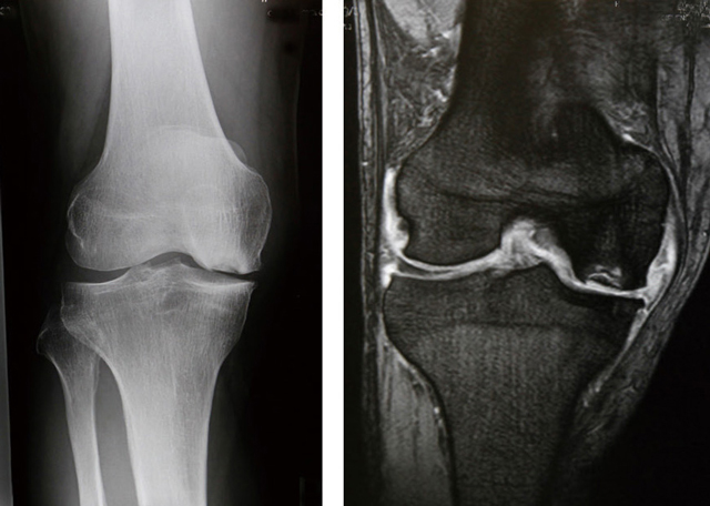 変形性膝関節症のレントゲンとMRI画像