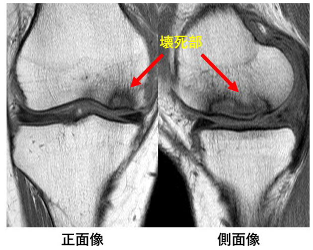 骨壊死のMRI画像