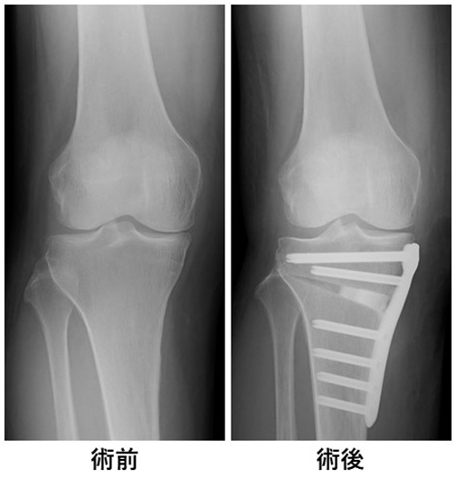 骨切り術のX線画像