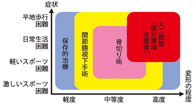 変形性膝関節症治療の考え方