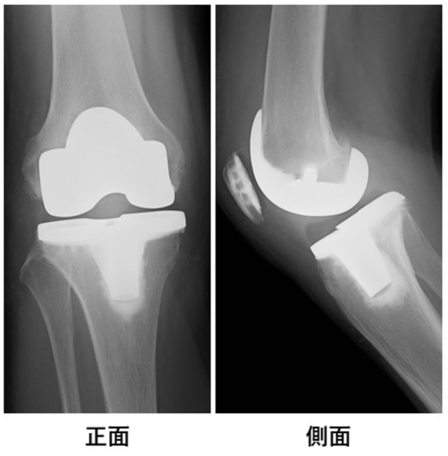 人工膝関節全置換術のX線画像