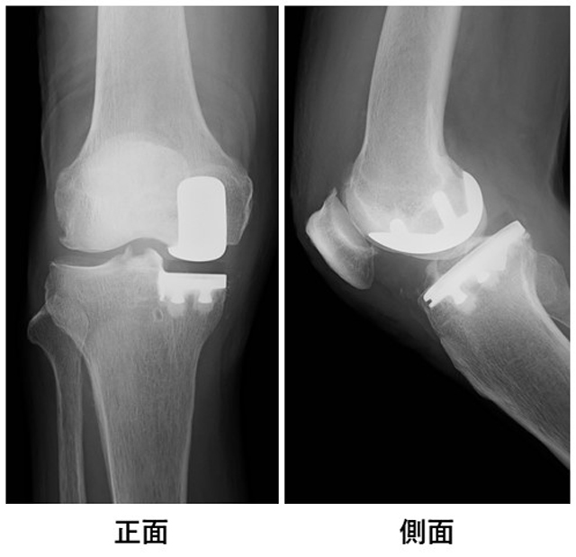 人工膝関節部分置換術のX線画像