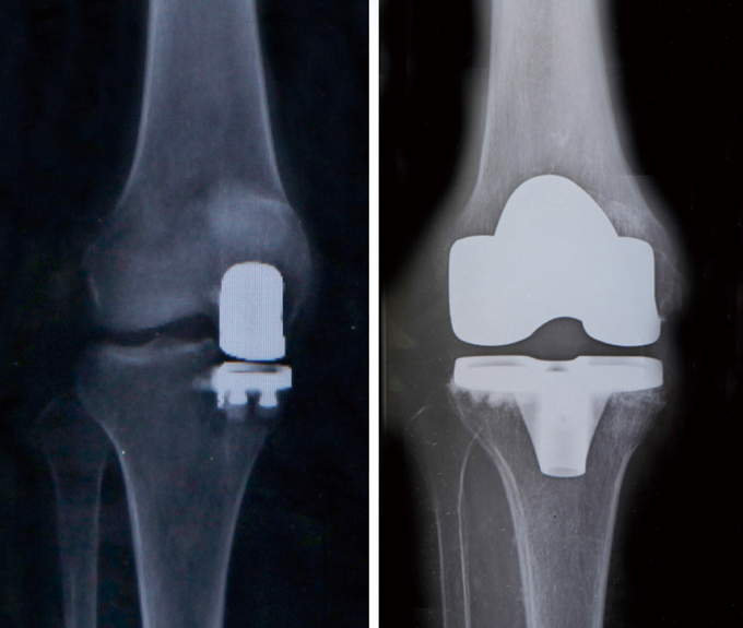 人工膝関節単顆（部分）置換術と全置換術後のレントゲン