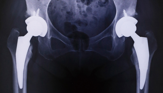 両側同時人工股関節置換術後のレントゲン