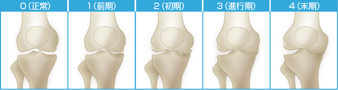 変形性膝関節症5段階