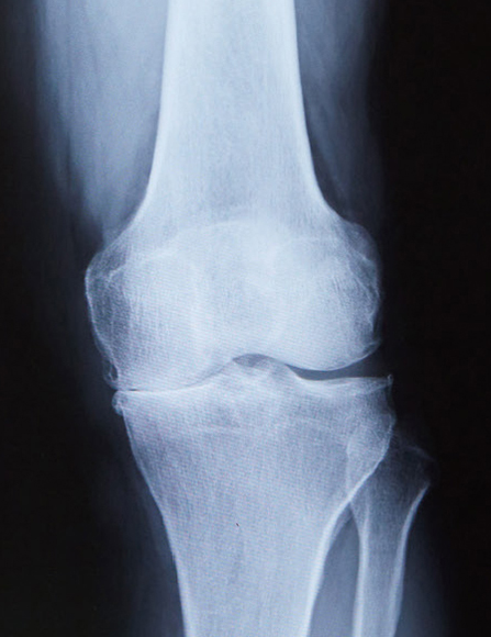 変形性膝関節症のレントゲン（内側の隙間がなくなっています）