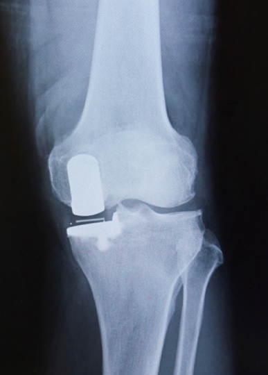 人工関節部分置換術後のレントゲン