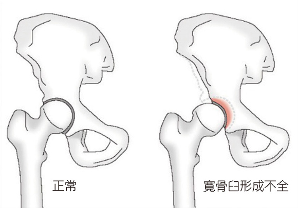 正常 寛骨臼形成不全