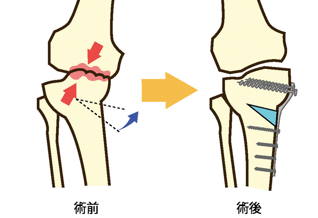 高位脛骨骨切り術