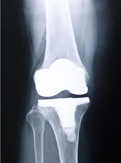人工膝関節置換術後のレントゲン