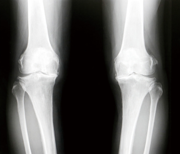 変形性膝関節症と変形性股関節症のレントゲン1